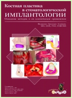 Костная пластика в стоматологической имплантологии / Ф. Альфаро